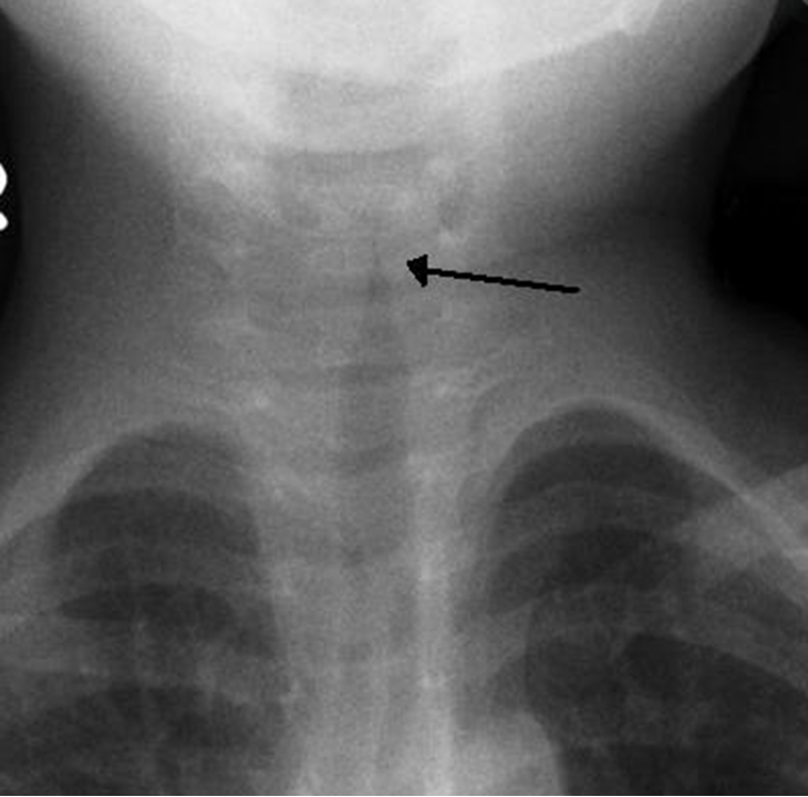 <p>What does this refer to</p><ul><li><p><span style="color: red"><strong>Steeple sign</strong></span> (subglottic narrowing of trachea)</p></li><li><p>Seen on AP neck x-ray</p></li></ul><p></p>
