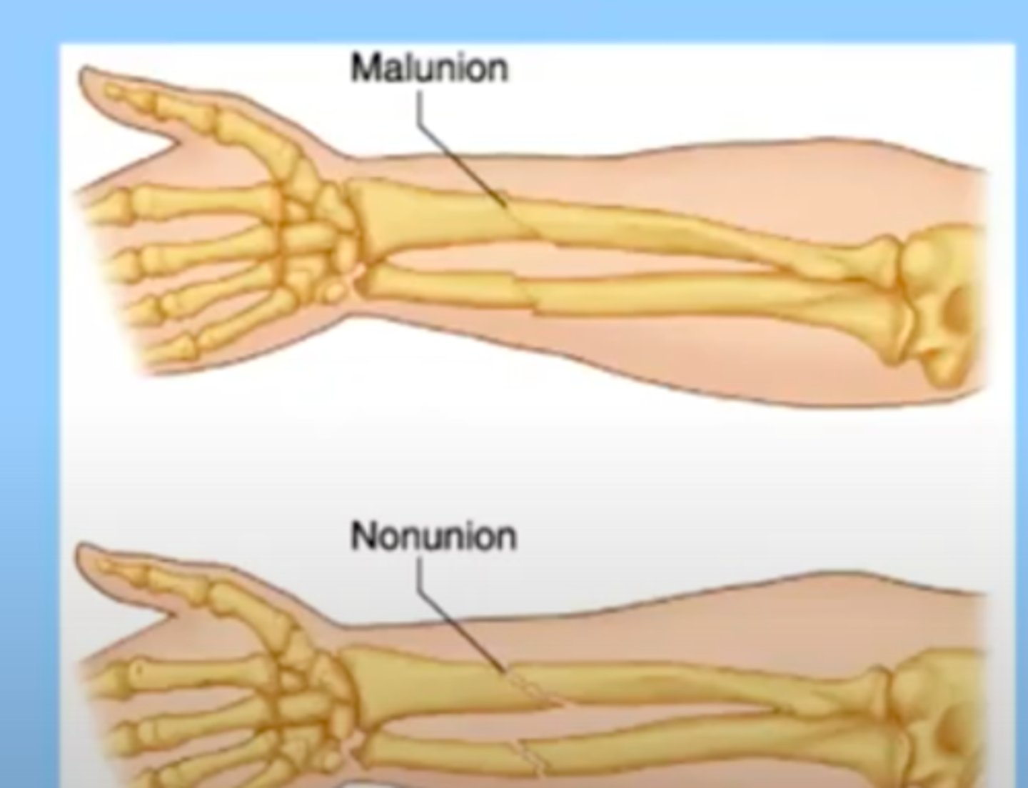 <p>takes longer than expected for a bone to heal</p><p>can be causes by malunion or nonunion</p><p>malunion: the bones are healing, but they were not completely line up/don't stay lined up</p><p>-may or may not require surgical intervention</p><p>nonunion: the reduction has not been successful and the bone segments are not in contact with each other</p>