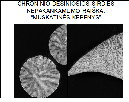 <p>“MUSKATINĖS KEPENYS”</p><p>išsiplėtusi centrinė vena, pilnakraujiški centr. kapiliarai</p><p>kraujo išsiliejimo plotai, sąstovinė splenomegalija</p><p>pakitimai skrandyje - gleivinė melsva, skrandžio gleivinės erozija</p>
