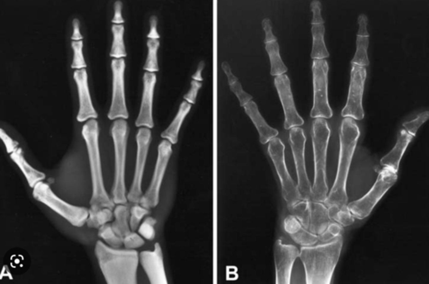 <p>low bone mineral density, can be postmenopausal or aged related, risks include exogenous steroid administration/Cushing's disease, estrogen deficiency, inadequate physical activity, alcoholism</p><p>Dexa scan is imaging study of choice</p>