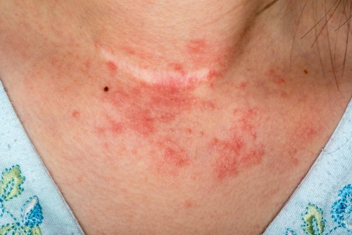 <ul><li><p>Caused by exposure to chemicals that provoke allergic reactions</p></li></ul><p></p>