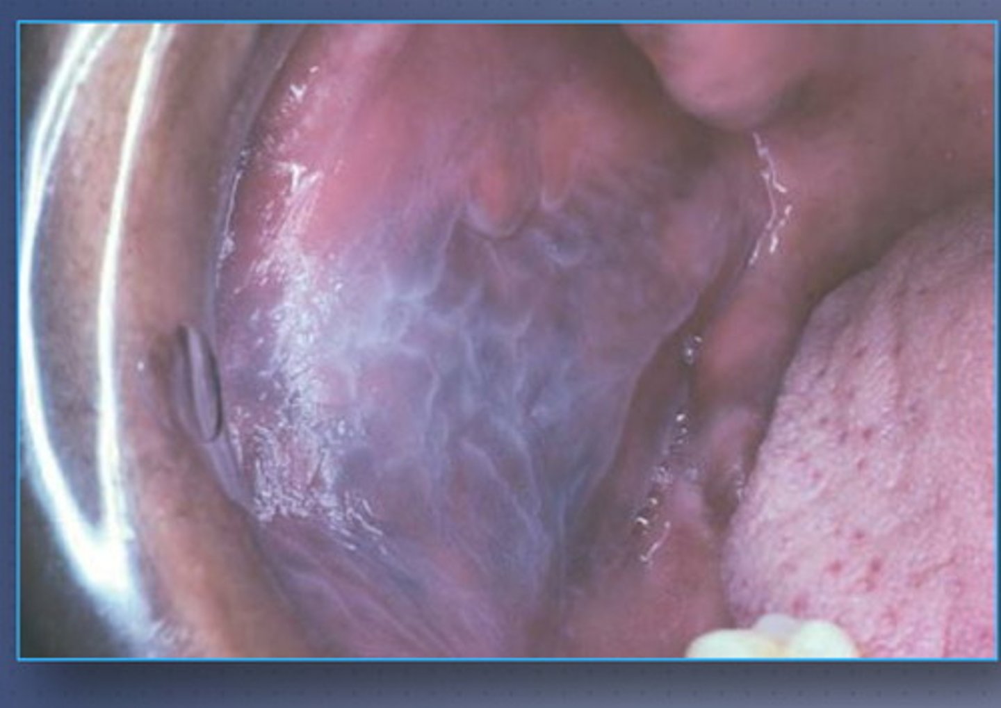 <p>Pic- Mucosa stretched out with white patch that disappears?</p>