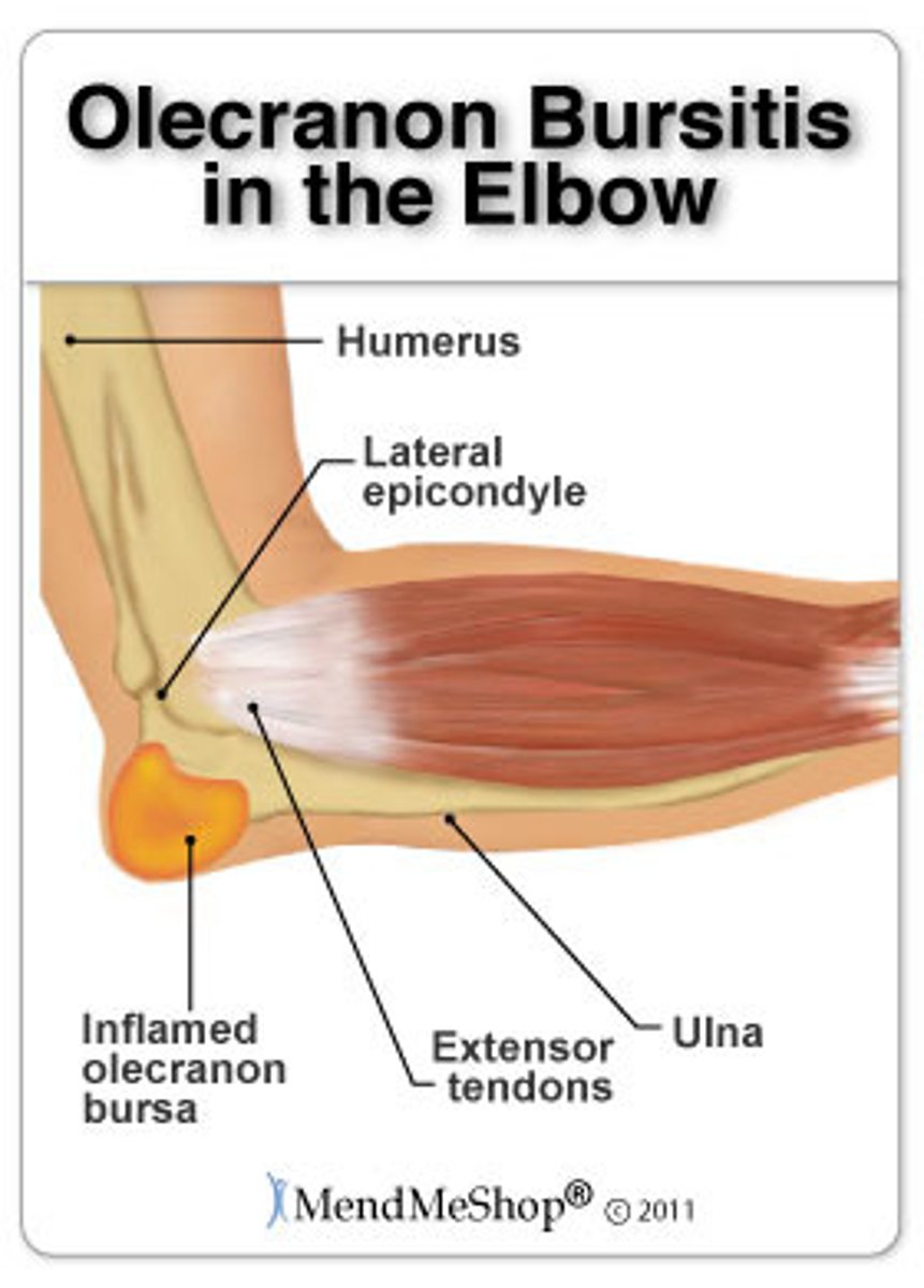 <p>Description: inflammation of a bursa, usually caused by a blow or friction</p><p>Symptoms: pain and swelling</p><p>Treatment: anti-inflammatory drugs, aspiration of excessive fluid.</p>