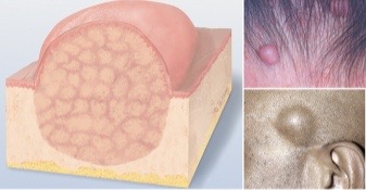 <p>a few centimeters or greater in diameter, may be soft or firm, can be benign or malignant</p>