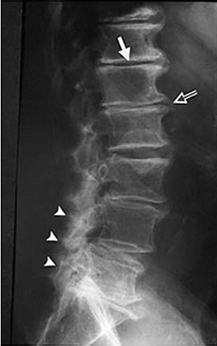 <p>•Xray: Decreased disc space, instability (anterolisthesis), obvious deformity</p><p>•CT Myelogram: If MRI is contraindicated (pacemaker, metallic implants)</p>