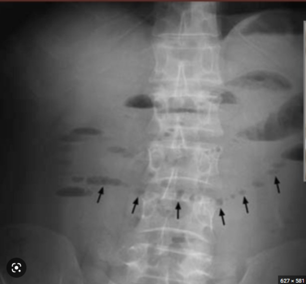 <p>“string of pearls” finding</p><p><em>Abdominal Radiograph</em></p>