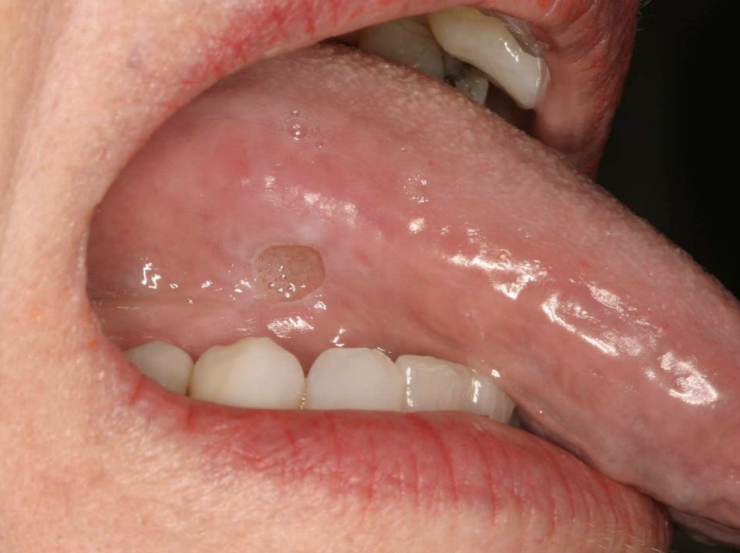 <p>white hyperkeratotic rim (may help&nbsp;distinguish from aphthous ulcers or SCCA)</p>
