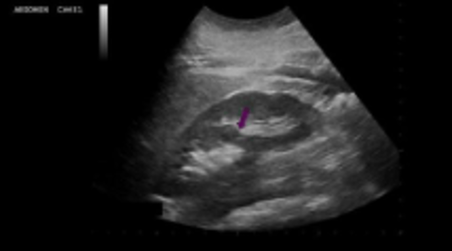<p>A normal variant in renal formation usually related to a duplicated collecting system</p>
