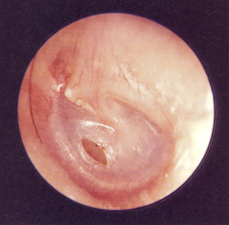 <p><u>disordered otoscopy: eardrum/TM</u></p><p>myringotomy</p>