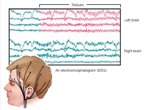 <p>noninvasive test that records electrical patterns in your brain. used to help diagnose conditions such as seizures, epilepsy, head injuries, etc. </p>