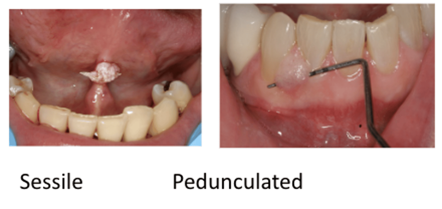 <p>sessile has a raised surface</p><p>pedunculate needs to the probe to raise it (mushroom shape)</p>