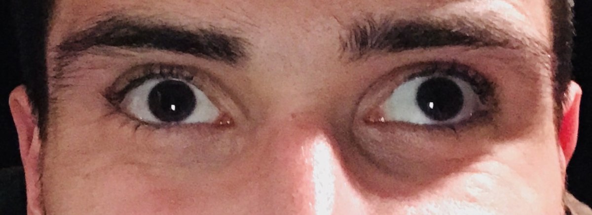 Is a congenital condition where both eyes do not focus on an object simultaneously; these eyes appear crossed. Impairment of the extraocular muscles or their nerve supply causes strabismus. 