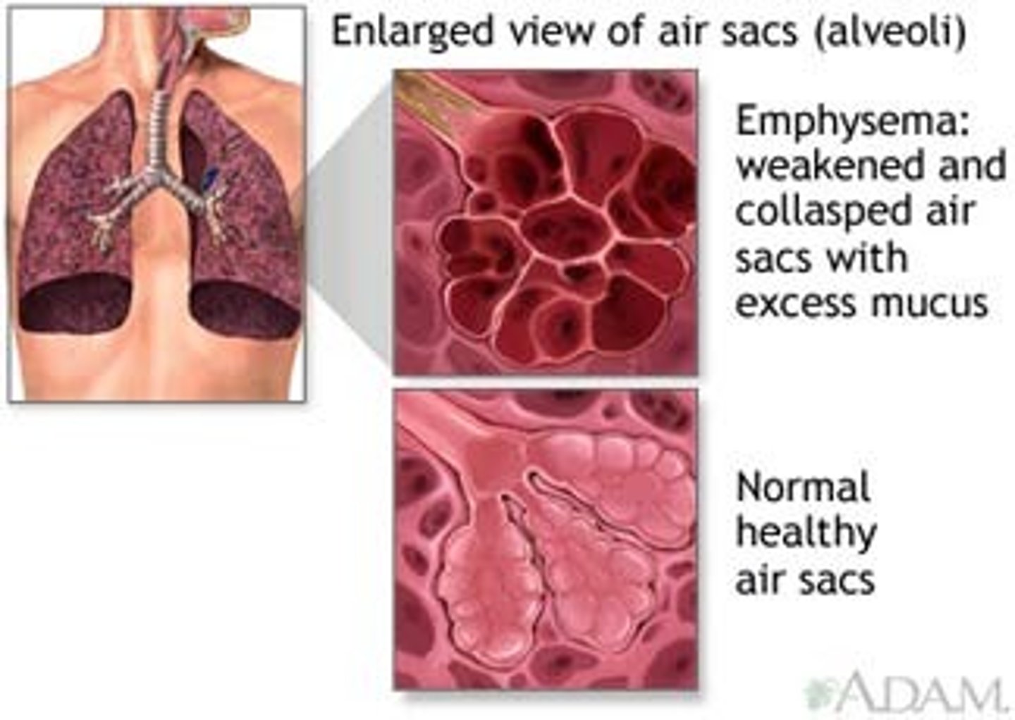 <p>Alveoli in the lungs become destroyed, therefore decreased surface area for gas exchange</p><p>Structure of alveoli changes (becomes stiffer) as it undergoes fibrosis. Therefore not all air is removed from sac, so gas exchange isn't occurring as efficiently.</p>