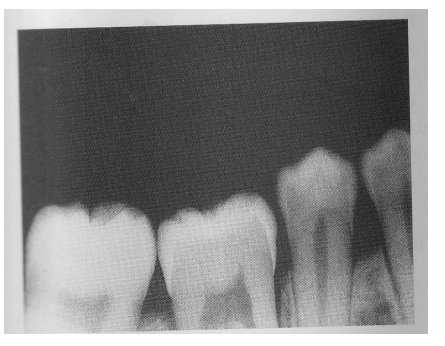 <ul><li><p>Failure to see the apices on a PA radiograph → no root tips</p><ul><li><p>Reason: Incorrect film placement </p></li></ul></li></ul><p></p>