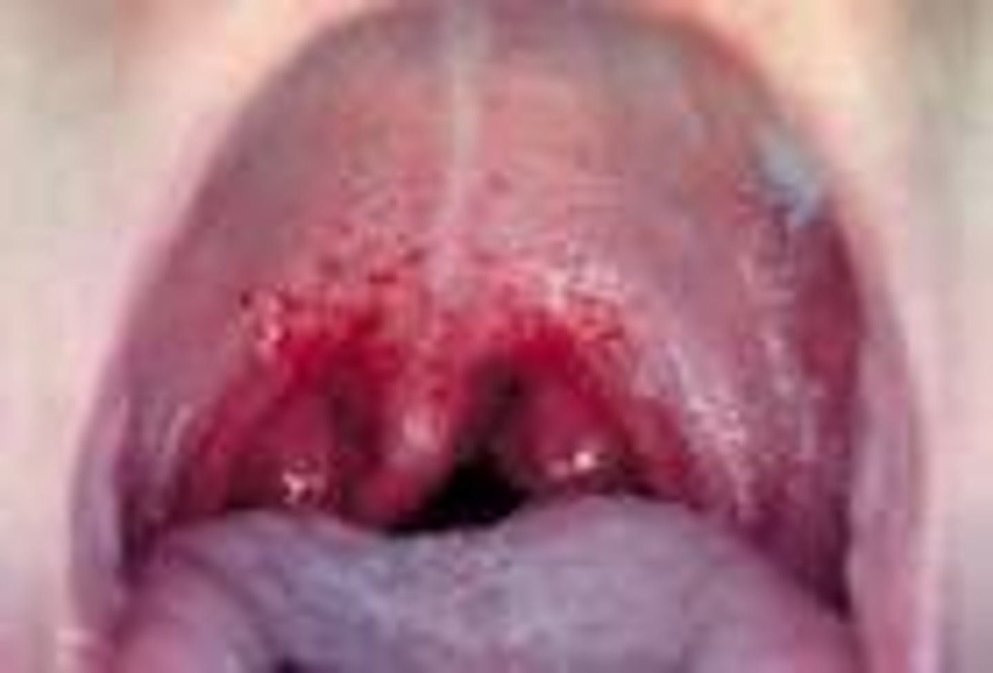 <p>CA: Streptococcus pyogenes<br>MOT: -resp. droplets -direct contact w/ infected indv.<br>Si/Sx: -reds spots in mouth -sore throat -F -dysphagia<br>Dx: -strep test strip/throat culture <br>Tx: -ABX (PCN, amoxicillin) -children's Tylenol</p>