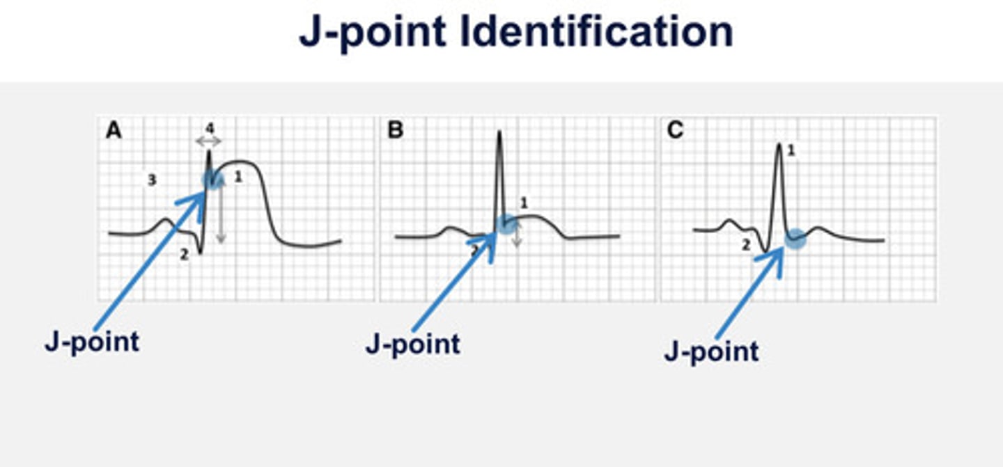 <p>Point where the QRS complex and ST segment meet</p>