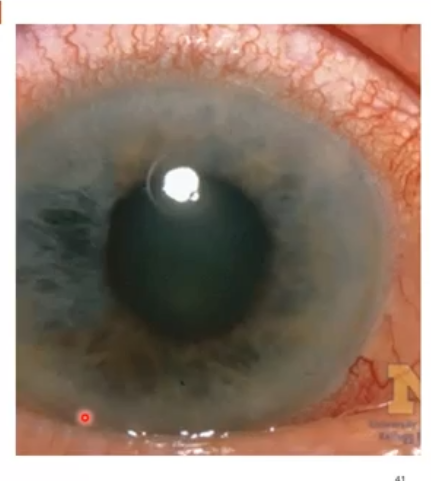 <p>very high iop </p>