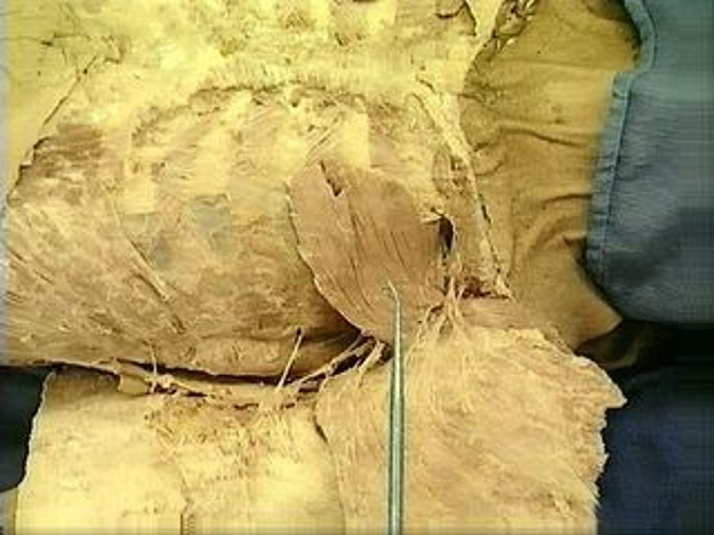<p>A flat triangular muscle which lies completely deep to the pectoralis major.</p>