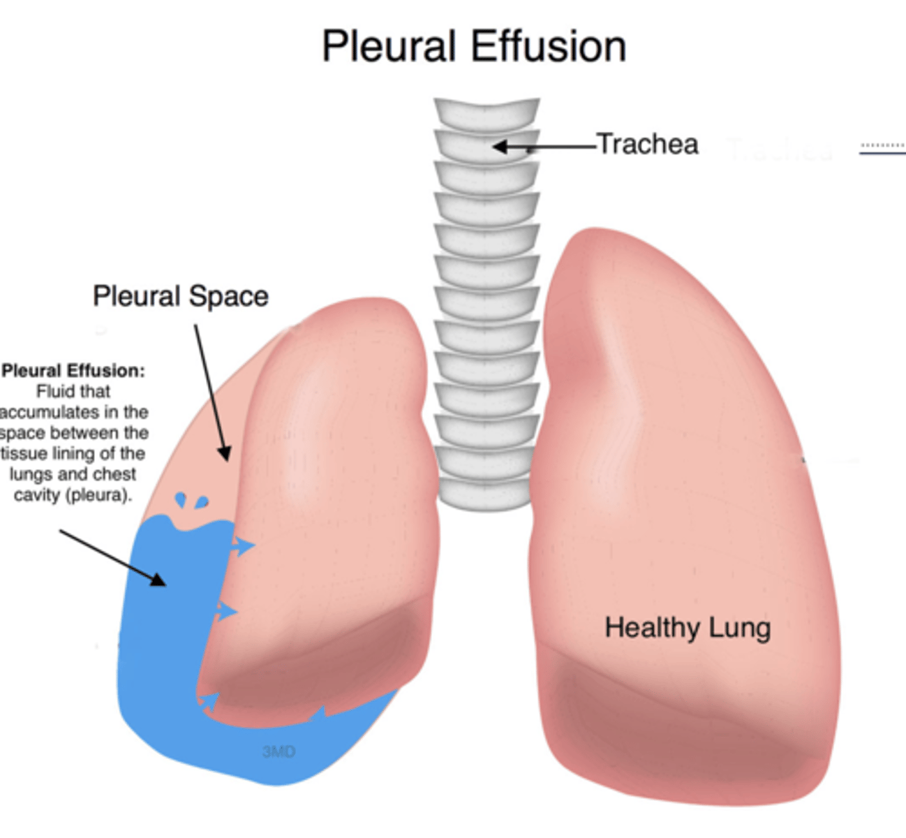 <p>Causes of pleural effusion</p>