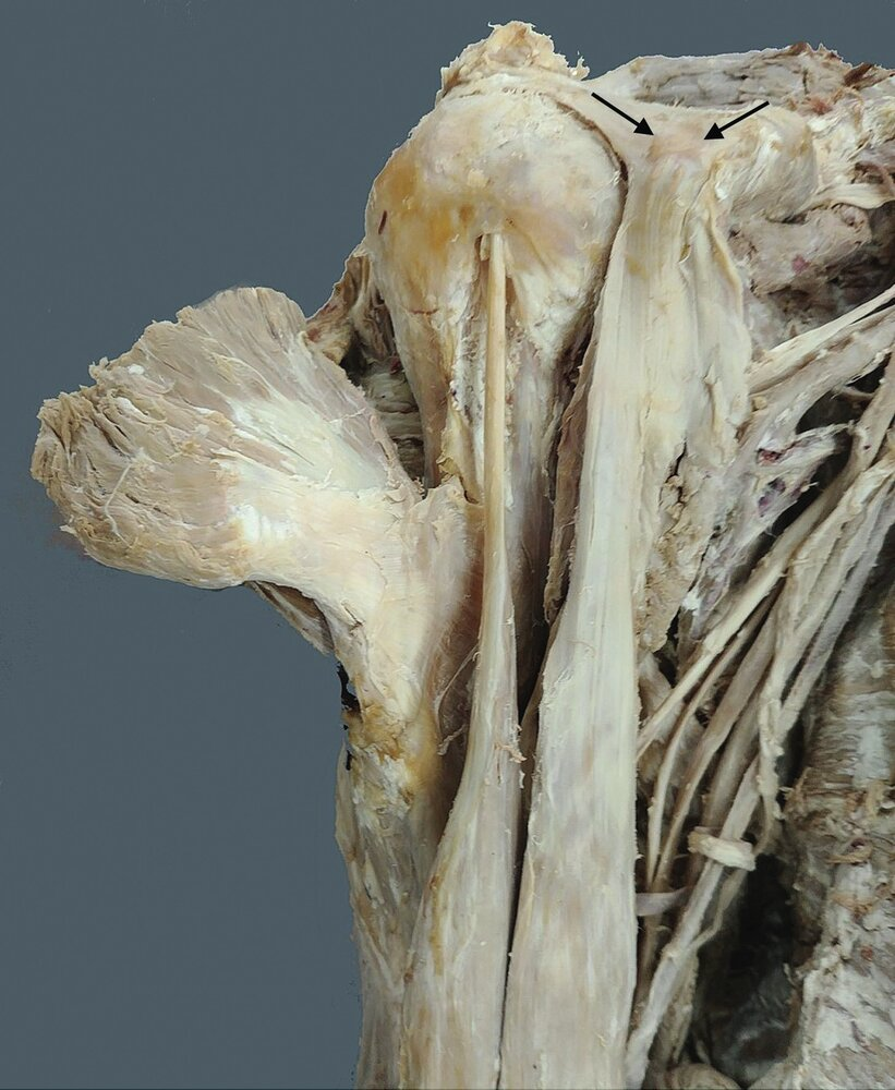 <p>17. The image shows a macroscopic specimen of the shoulder region.</p><p>The structure marked with arrows in the image is:</p><p>A. Not palpable in a living person</p><p>B. A part of the clavicle (collarbone)</p><p>C. A part of the scapula (shoulder blade)</p><p>D. A part of the humerus (upper arm bone)</p><p>E. The origin of the long head of the biceps brachii muscle</p>