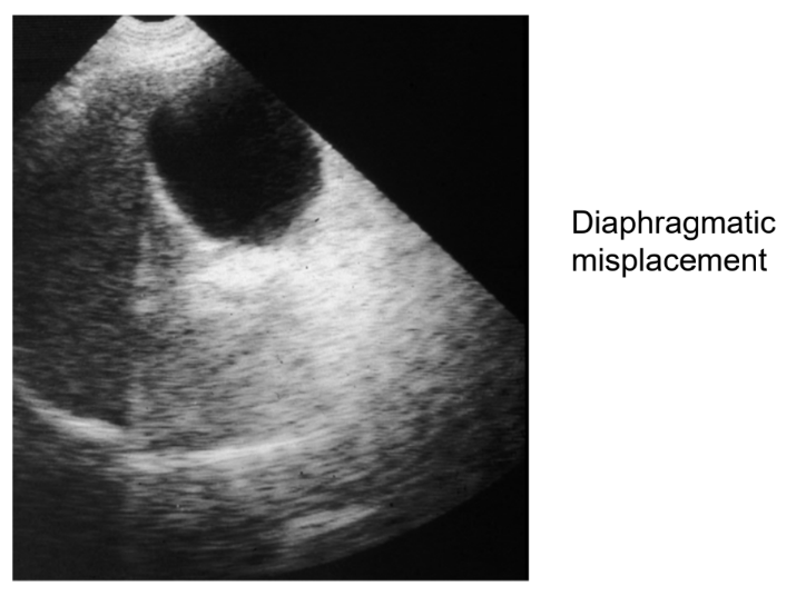 <p>Where the interface is mispositioned lateral to its true position.</p>
