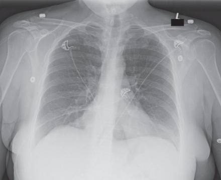 <ul><li><p>structures shown:</p><ul><li><p>anatomy of thorax:</p><ul><li><p>heart</p></li><li><p>trachea</p></li><li><p>ribs</p></li><li><p>diaphragmatic domes</p></li><li><p>entire lung fields</p></li><li><p>vascular markings</p></li></ul></li><li><p>evaluation criteria:</p><ul><li><p>no motion; well-defined diaphragmatic domes and lung fields</p></li><li><p>lung fields in their entirety including costophrenic angles</p></li><li><p>pleural markings</p></li><li><p>ribs and thoracic intervertebral disk spaces faintly visible through heart shadow</p></li><li><p>no rotation; medial portion of clavicles and alteral border of ribs equidistant from vertebral column</p></li></ul></li></ul></li></ul><p></p>