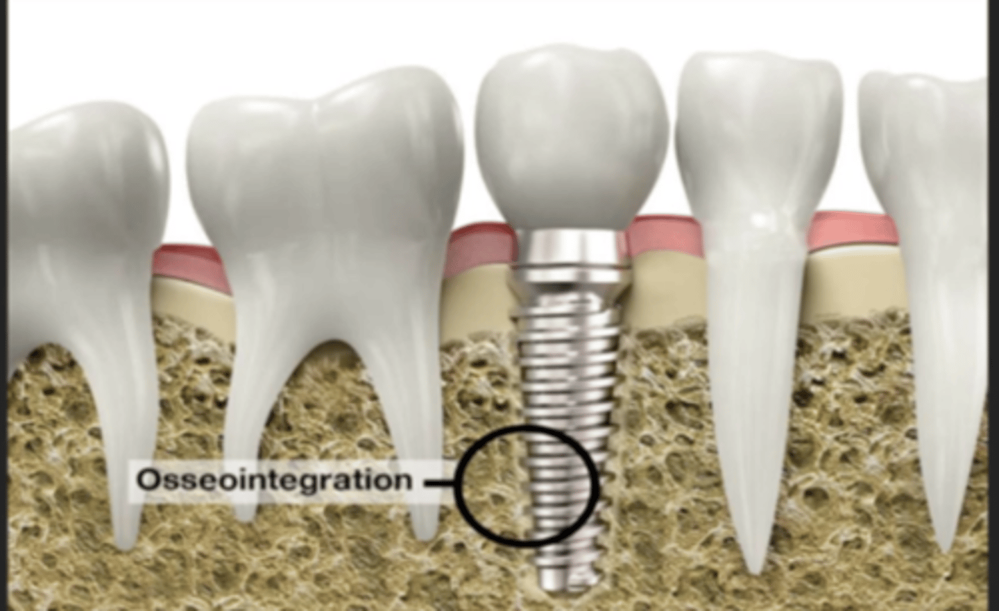 <p>direct contact of bone with the implant surface --> another word is ankylose</p><p>functionally stable attachment between bone and implant without any CT </p><p>bone grows and attaches to threads of the implant </p>