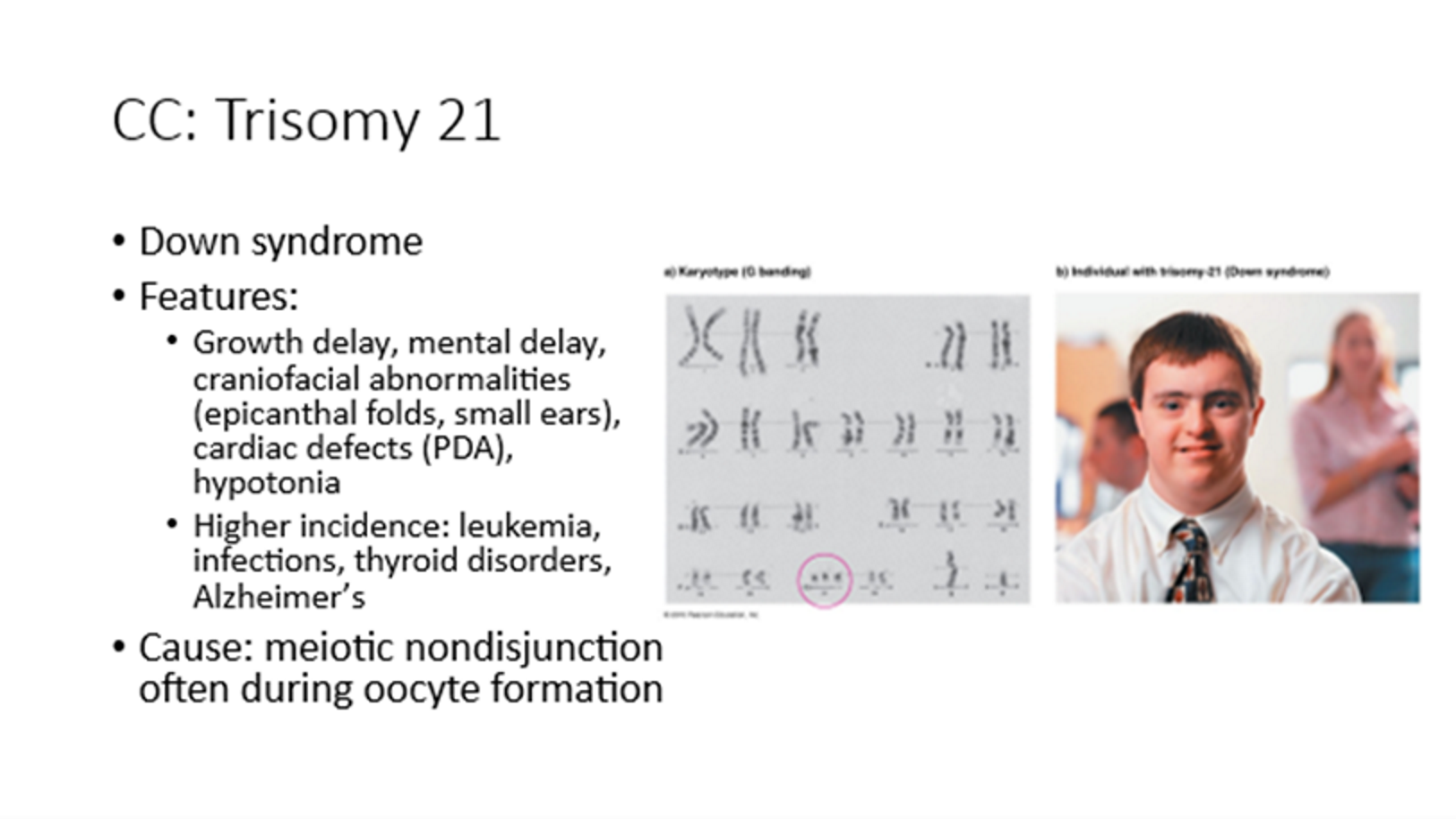 <p>Down syndrome</p><p>Caused by <strong>meiotic nondisjunction</strong></p><p>Growth and mental delay, craniofacial abnormalities, cardiac defects</p>