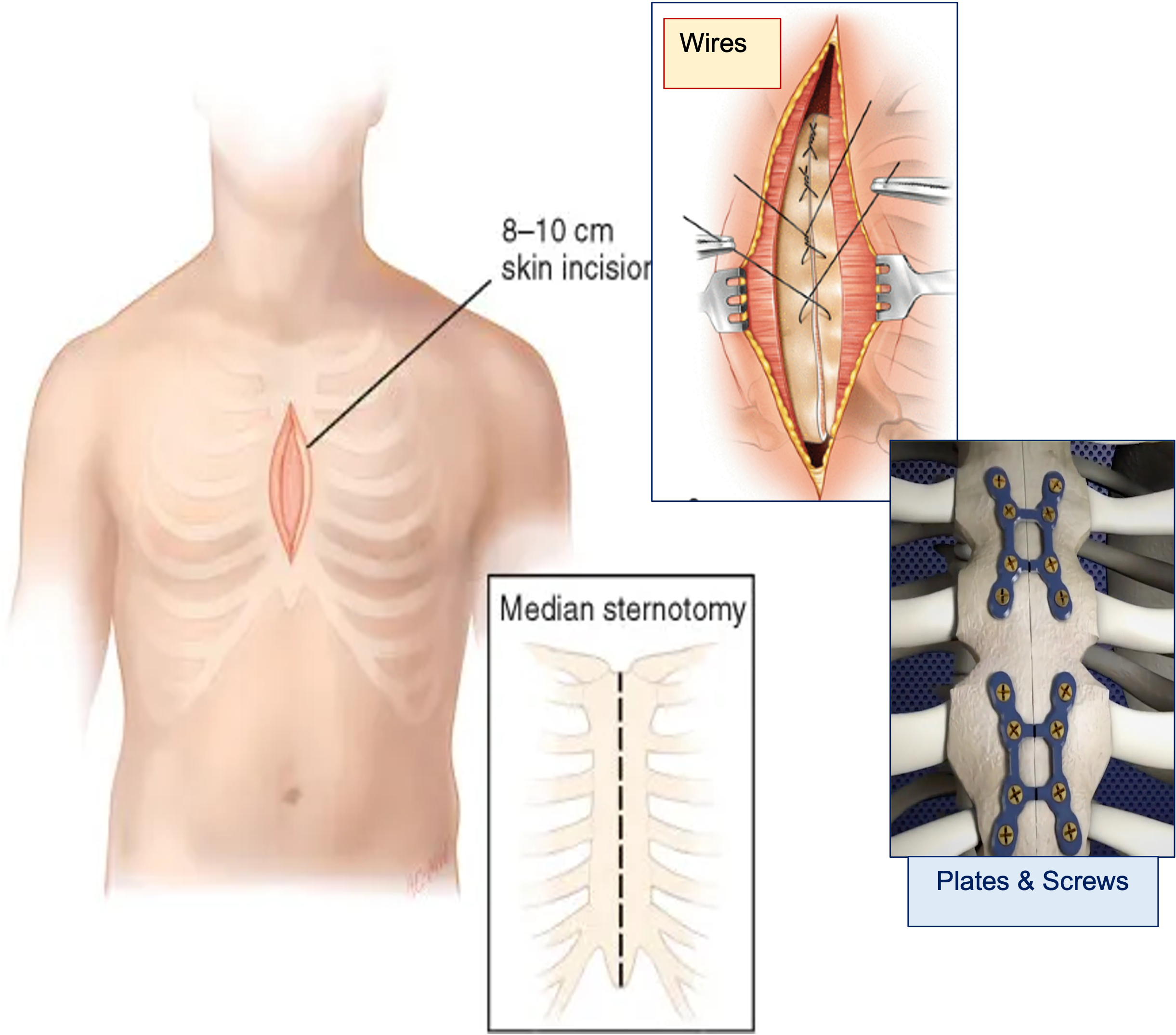 <ul><li><p class=""><strong>Incision:</strong> </p><ul><li><p class="">Vertical cut through the <strong>sternum</strong> </p></li><li><p class="">just below the neck to below the sternum</p></li></ul></li><li><p class=""><strong>Access:</strong> Both lungs, heart and mediastinum</p></li><li><p class=""><strong>Commonly used for:</strong></p><ul><li><p class="">Cardiac surgeries </p></li><li><p class="">(e.g., CABG, valve replacement)</p></li><li><p class="">Bilateral lung procedures</p></li></ul></li></ul><p></p>