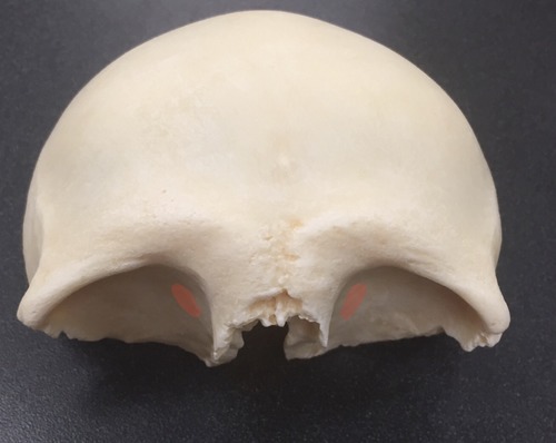 two names for the small medial depression on the frontal bone behind the medial aspect of the superior orbital margin; the cartilaginous pulley for the tendon of the superior oblique muscle lies here in the anterior-medial portion of the orbital roof