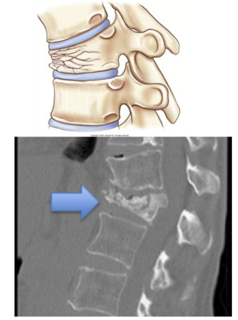 <p>Vertebral fracture displays as decreased vertical dimension of anterior vertebral body</p><ul><li><p>Lower t-spine usually</p></li></ul><p></p>