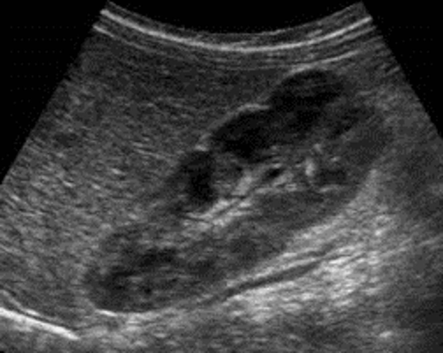 <p>an uncommon condition that causes the surface of the kidney to appear as several lobules instead of smooth, flat and continuous.</p>