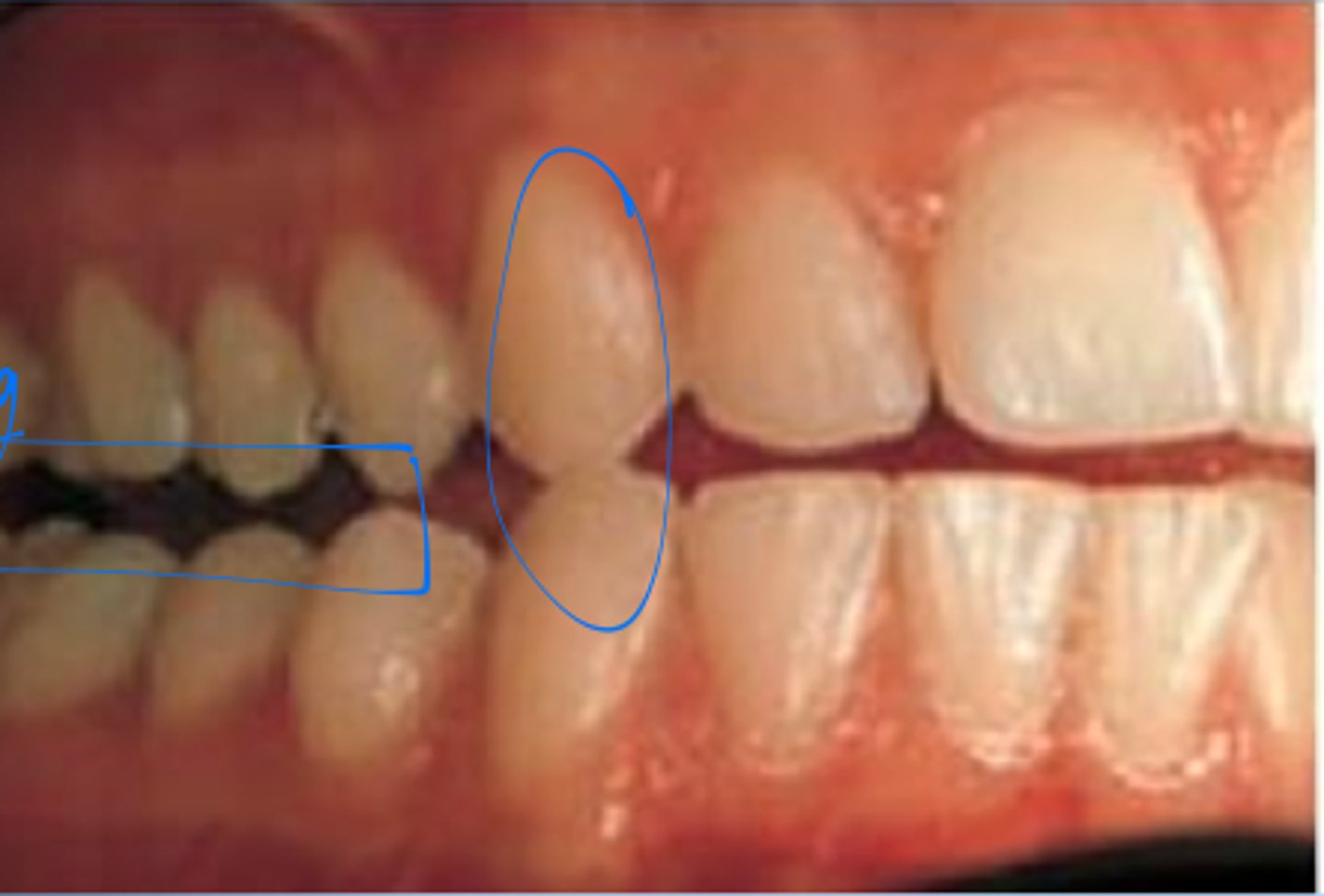 <p>occlusal relationship in which the vertical overlap of the maxillary and mandibular canines produces a disclusion of all the posterior teeth when the mandible moves to either side</p>