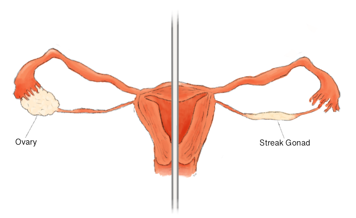 <p>What type of gonads to those with Swyer Syndrome get?</p>