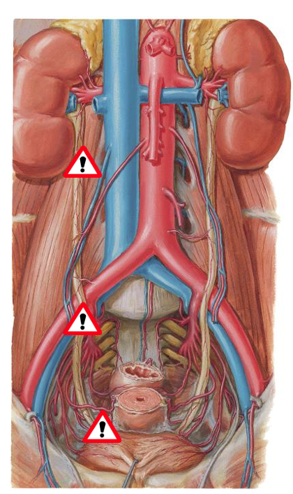 <p><span>1)Overgang fra pelvis renalis à ureter</span></p><p><span>2)Ved krydsning af linea terminalis (indgang til bækkenet)</span></p><p><span>3)Ved passagen gennem vescica urinaria (snævreste)</span></p>