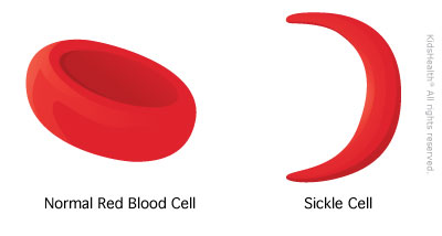 * Disease causing red blood cells to become hard, sticky, and look like a C-shaped structure called a “sickle”


* Makes haemoglobin levels become clinically low
* Caused by a mutation, specifically the 6th codon for the beta chain of haemoglobin