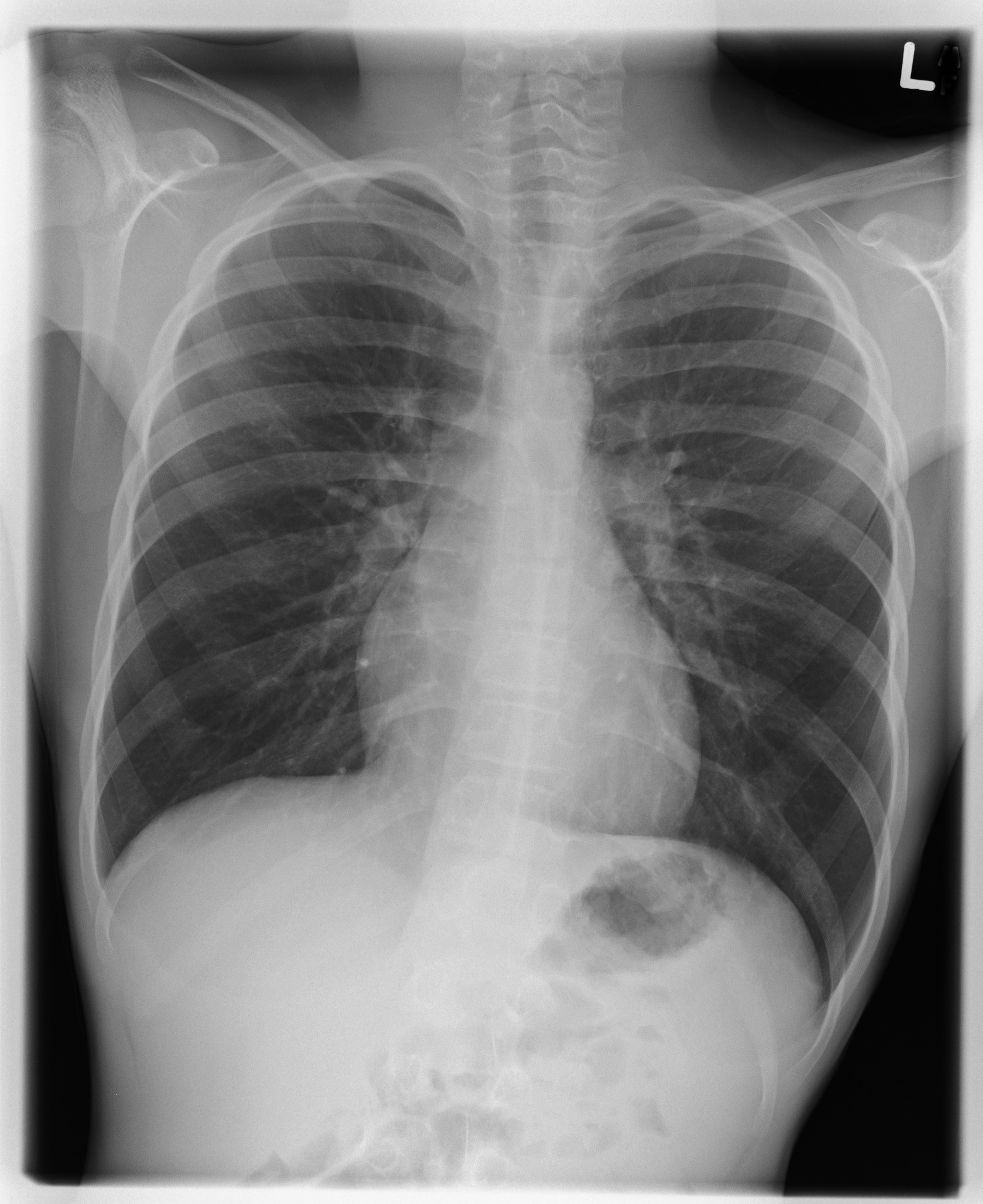 <p>Uneven lung apices; clavicles at unequal heights; chest longitudinal axis not parallel to IR.</p>