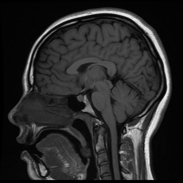 <p>a plane of dissection that divides the brain in two from the median</p>