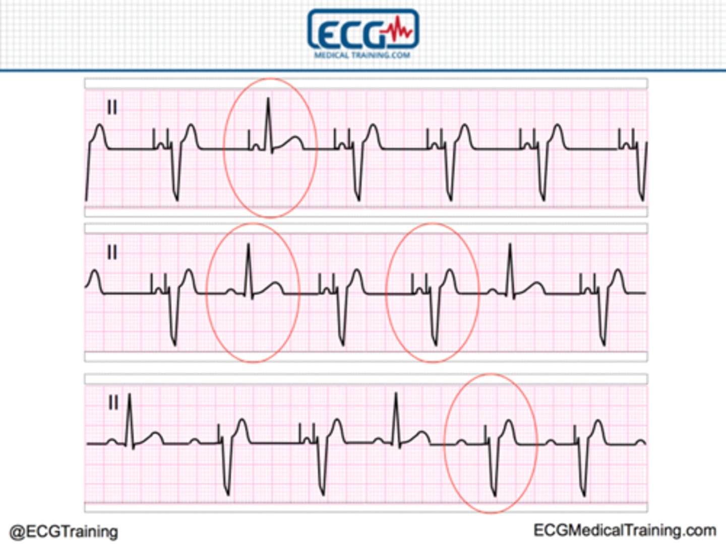 <p>Dual chamber: both atrial and ventricular are paced</p>