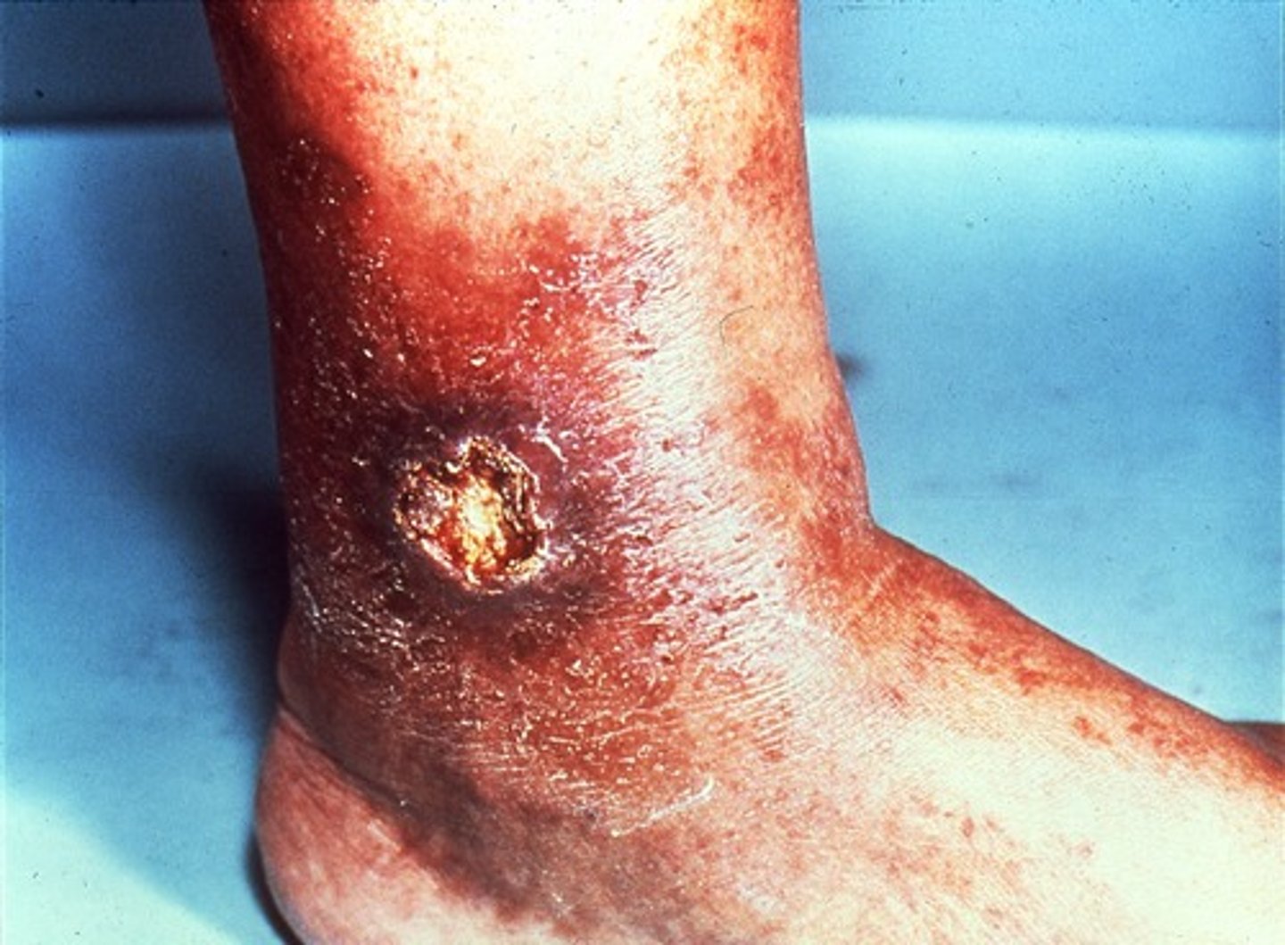 <p>-dull achy pain</p><p>-lower leg edema</p><p>-pulse present</p><p>-drainage</p><p>- sores w/ irregular borers</p><p>- yellow slough or ruddy skin</p><p>-location on ankles</p>