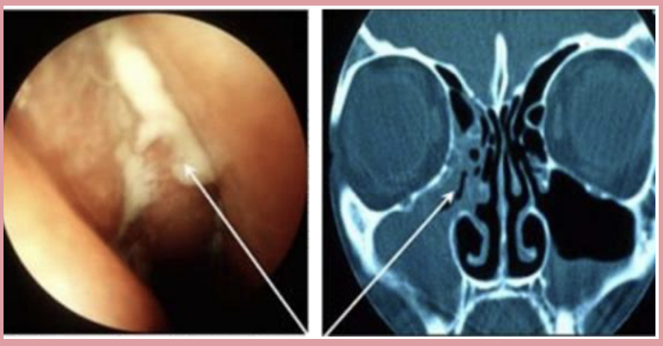 <p>CT scan showing the discharge coming out of the middle meatus and the pus within the maxillary sinus and that of the ethmoid sinuses more pronounced at the right side of the px.</p>
