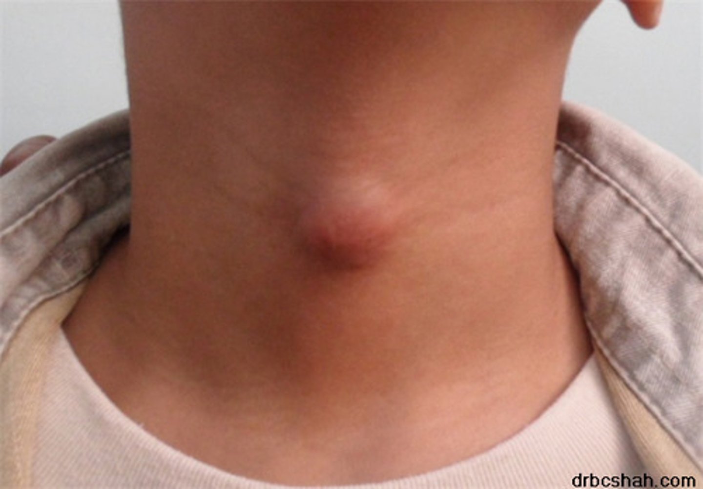 <p>A mass or lump in the front part of neck that is filled with fluid.</p>