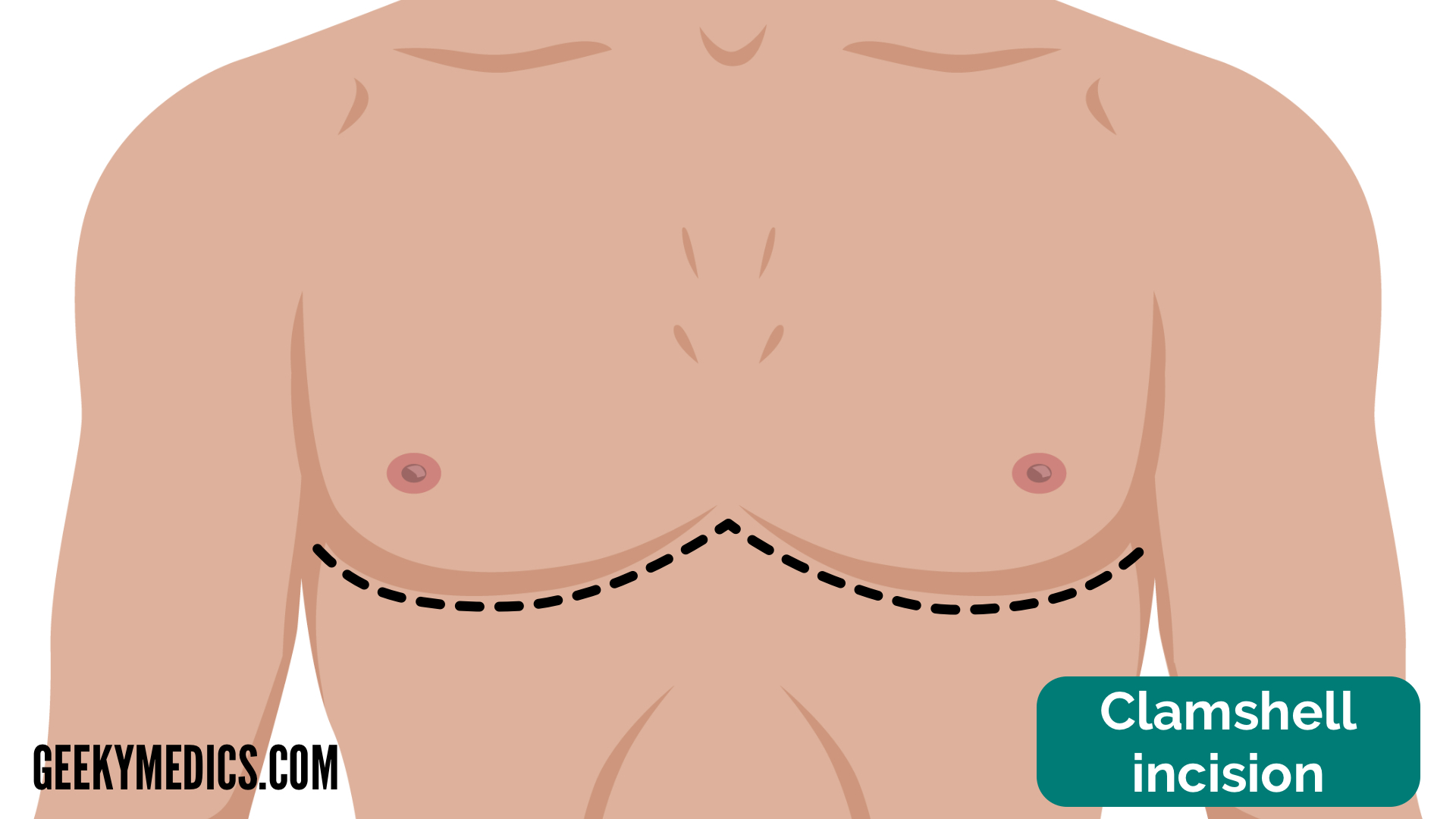 <ul><li><p class=""><strong>Incision:</strong> </p><ul><li><p class="">Bilateral <strong>transverse thoracotomy</strong> </p></li><li><p class="">across the chest (under the breasts), </p></li><li><p class="">joining both sides </p></li><li><p class="">→ opens chest like a clamshell</p></li></ul></li><li><p class=""><strong>Access:</strong> Both lungs, entire mediastinum, heart, great vessels</p></li><li><p class=""><strong>Used for:</strong></p><ul><li><p class=""><strong>Bilateral lung transplantation</strong></p></li><li><p class="">Extensive trauma</p></li><li><p class="">Mediastinal tumors</p></li></ul></li></ul><p></p>
