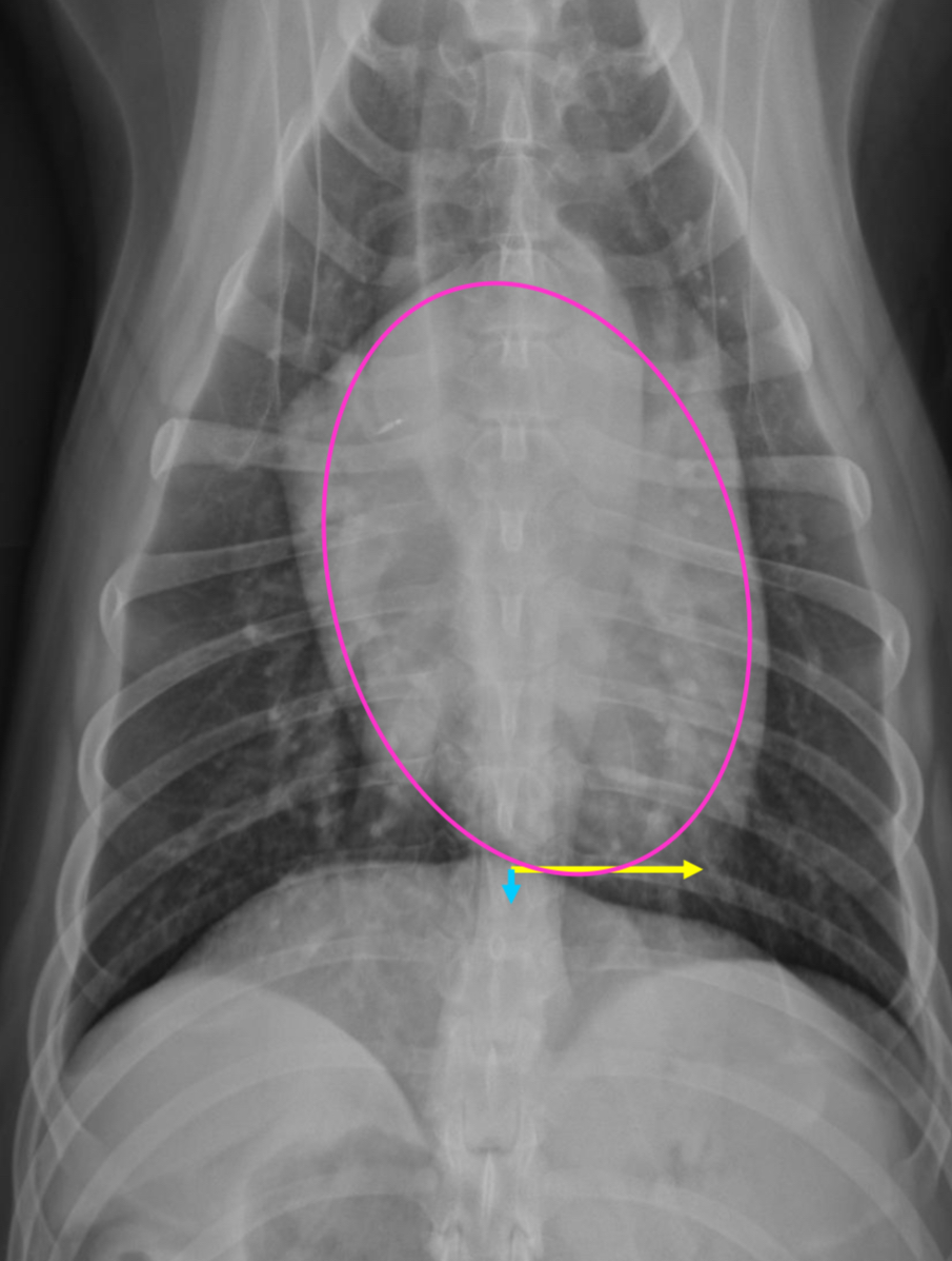 <p>-more elongated</p><p>-apex MORE to left of midline</p><p>-less separation between heart and cupula</p>