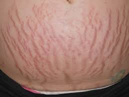 <p>= silvery, white, linear jagged marks 1-6 cm long caused by rapid or prolonged stretching, obesity, ascites, and hormones</p>