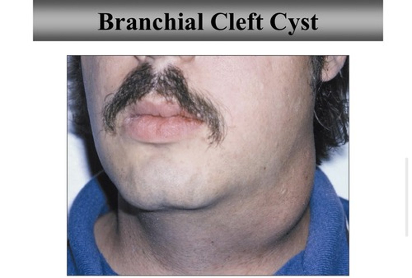 <p>- cause: epithelium trapped in lymph node/lymphoid tissue at development</p><p>- population: young adults</p><p>- location: lateral neck, floor of mouth or ventral/posterior tongue</p>