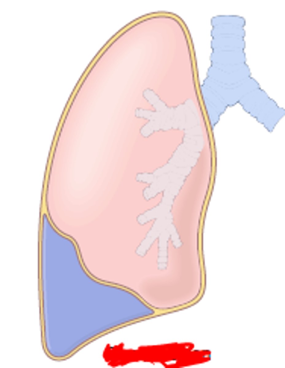 <p>compression (passive) atelectasis</p>