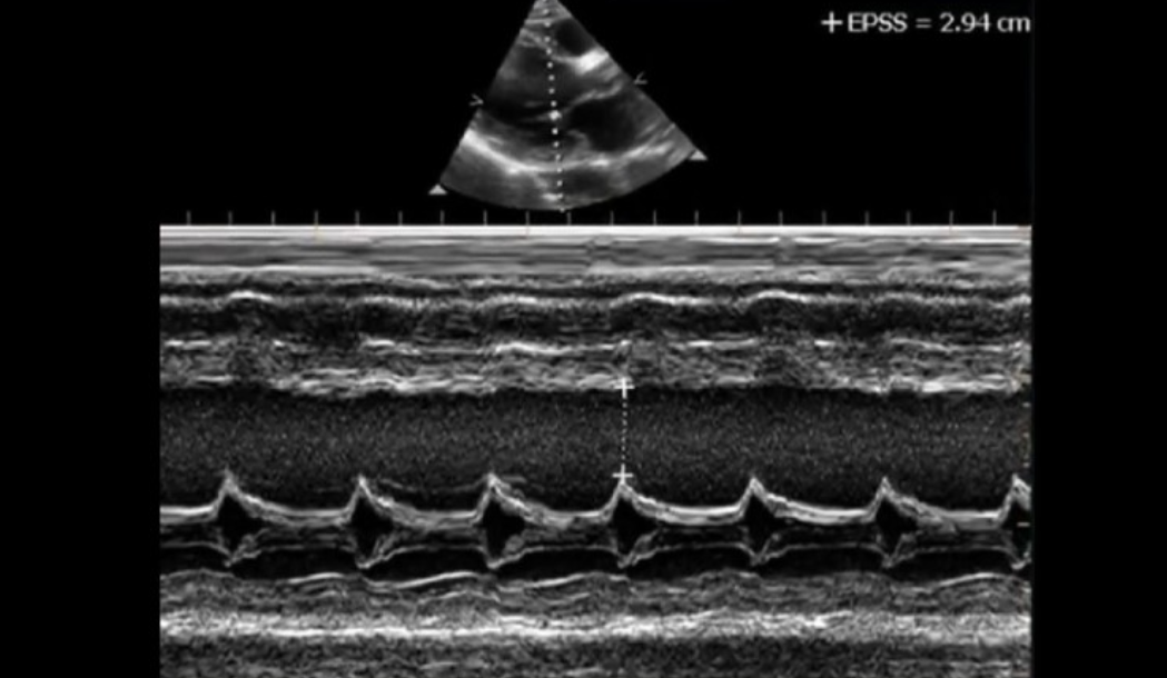 <p>What m-mode measurement will increase in patients with DCM? </p>