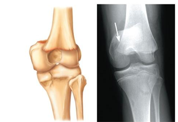 <p>Epiphysis separates from the diaphysis along the epiphyseal plate. Tends to occur when cartilage cells are dying and calcification of the matrix is occuring</p>