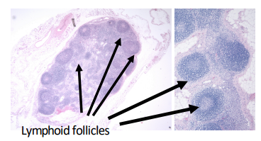 <p>What would you see looking at lymphoplasmacytic inflammation under the microscope?</p>